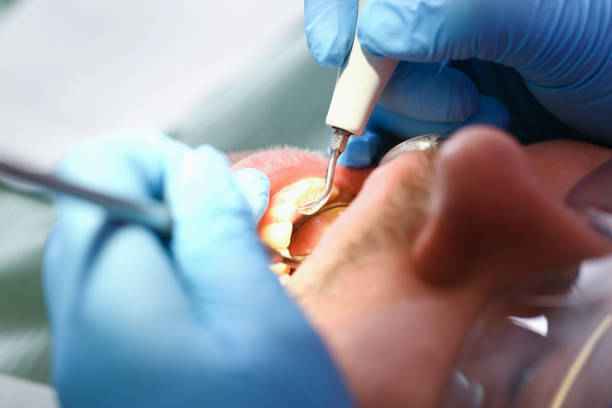 Best Emergency Tooth Extraction in Hartwell, GA
